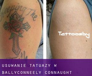 Usuwanie tatuaży w Ballyconneely (Connaught)