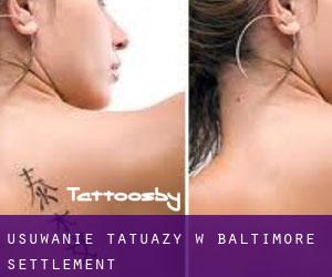 Usuwanie tatuaży w Baltimore Settlement