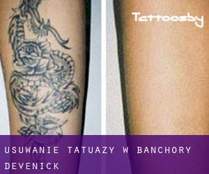 Usuwanie tatuaży w Banchory Devenick