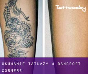 Usuwanie tatuaży w Bancroft Corners