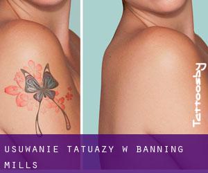 Usuwanie tatuaży w Banning Mills