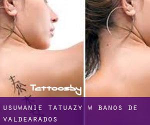 Usuwanie tatuaży w Baños de Valdearados