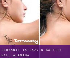 Usuwanie tatuaży w Baptist Hill (Alabama)
