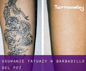 Usuwanie tatuaży w Barbadillo del Pez