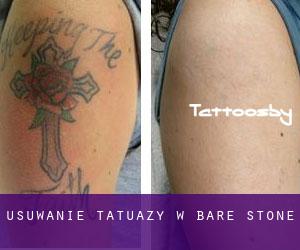 Usuwanie tatuaży w Bare Stone
