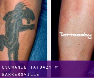 Usuwanie tatuaży w Barkersville