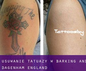 Usuwanie tatuaży w Barking and Dagenham (England)