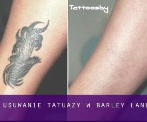 Usuwanie tatuaży w Barley Lane