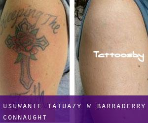 Usuwanie tatuaży w Barraderry (Connaught)