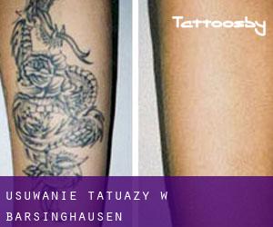 Usuwanie tatuaży w Barsinghausen