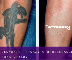 Usuwanie tatuaży w Bartlebaugh Subdivision