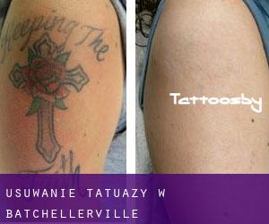 Usuwanie tatuaży w Batchellerville