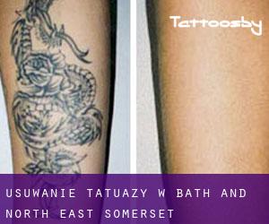 Usuwanie tatuaży w Bath and North East Somerset