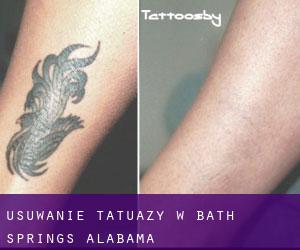 Usuwanie tatuaży w Bath Springs (Alabama)