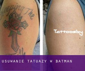 Usuwanie tatuaży w Batman