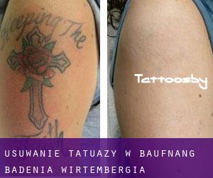 Usuwanie tatuaży w Baufnang (Badenia-Wirtembergia)