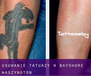 Usuwanie tatuaży w Bayshore (Waszyngton)