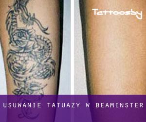 Usuwanie tatuaży w Beaminster