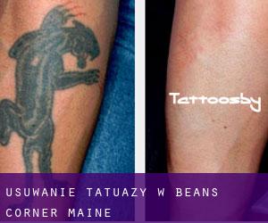 Usuwanie tatuaży w Beans Corner (Maine)
