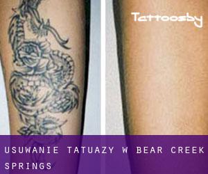 Usuwanie tatuaży w Bear Creek Springs
