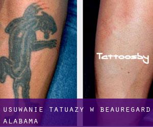 Usuwanie tatuaży w Beauregard (Alabama)