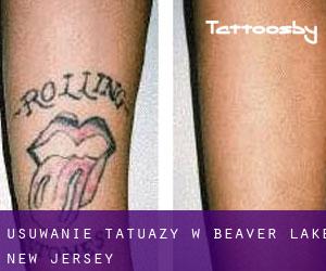 Usuwanie tatuaży w Beaver Lake (New Jersey)