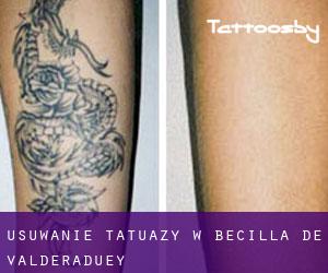 Usuwanie tatuaży w Becilla de Valderaduey