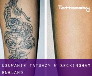 Usuwanie tatuaży w Beckingham (England)
