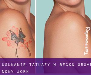 Usuwanie tatuaży w Becks Grove (Nowy Jork)