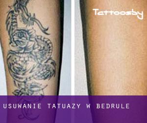 Usuwanie tatuaży w Bedrule