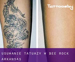 Usuwanie tatuaży w Bee Rock (Arkansas)