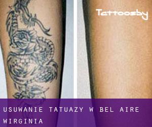 Usuwanie tatuaży w Bel-Aire (Wirginia)
