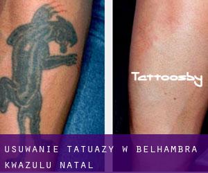 Usuwanie tatuaży w Belhambra (KwaZulu-Natal)