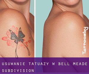 Usuwanie tatuaży w Bell Meade Subdivision