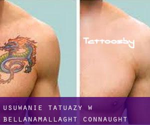 Usuwanie tatuaży w Bellanamallaght (Connaught)