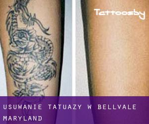 Usuwanie tatuaży w Bellvale (Maryland)