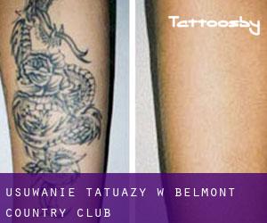 Usuwanie tatuaży w Belmont Country Club