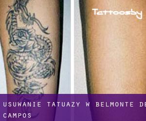 Usuwanie tatuaży w Belmonte de Campos