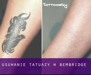 Usuwanie tatuaży w Bembridge