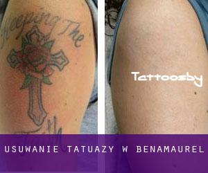 Usuwanie tatuaży w Benamaurel