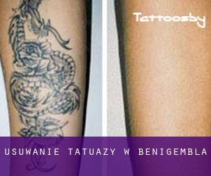 Usuwanie tatuaży w Benigembla