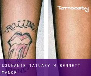 Usuwanie tatuaży w Bennett Manor