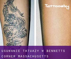 Usuwanie tatuaży w Bennetts Corner (Massachusetts)
