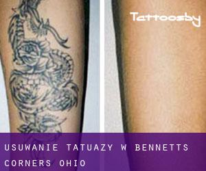 Usuwanie tatuaży w Bennetts Corners (Ohio)