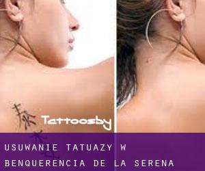 Usuwanie tatuaży w Benquerencia de la Serena