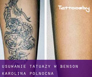Usuwanie tatuaży w Benson (Karolina Północna)
