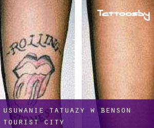 Usuwanie tatuaży w Benson Tourist City