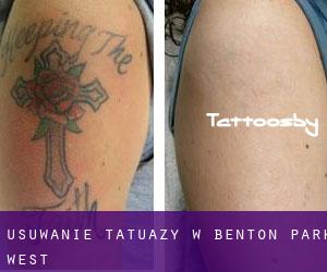 Usuwanie tatuaży w Benton Park West