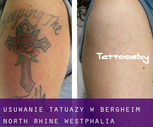 Usuwanie tatuaży w Bergheim (North Rhine-Westphalia)