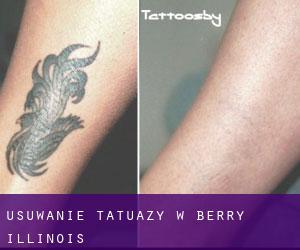 Usuwanie tatuaży w Berry (Illinois)